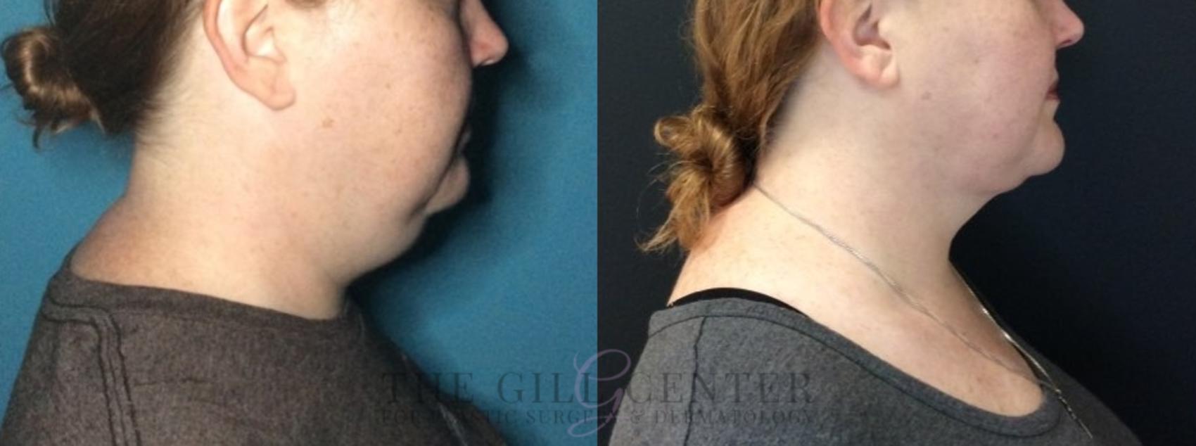 Liposuction Case 448 Before & After Right Side | The Woodlands, TX | The Gill Center for Plastic Surgery and Dermatology