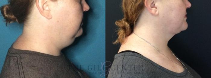 Liposuction Case 448 Before & After Right Side | The Woodlands, TX | The Gill Center for Plastic Surgery and Dermatology