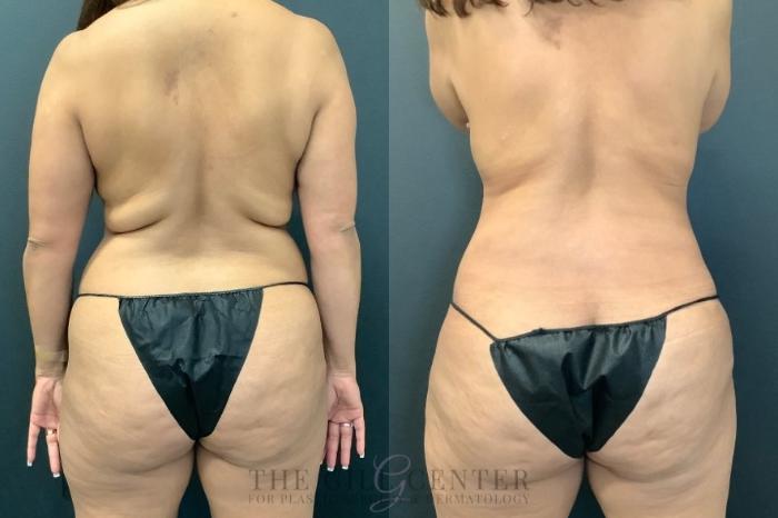 Liposuction Case 493 Before & After Back | The Woodlands, TX | The Gill Center for Plastic Surgery and Dermatology