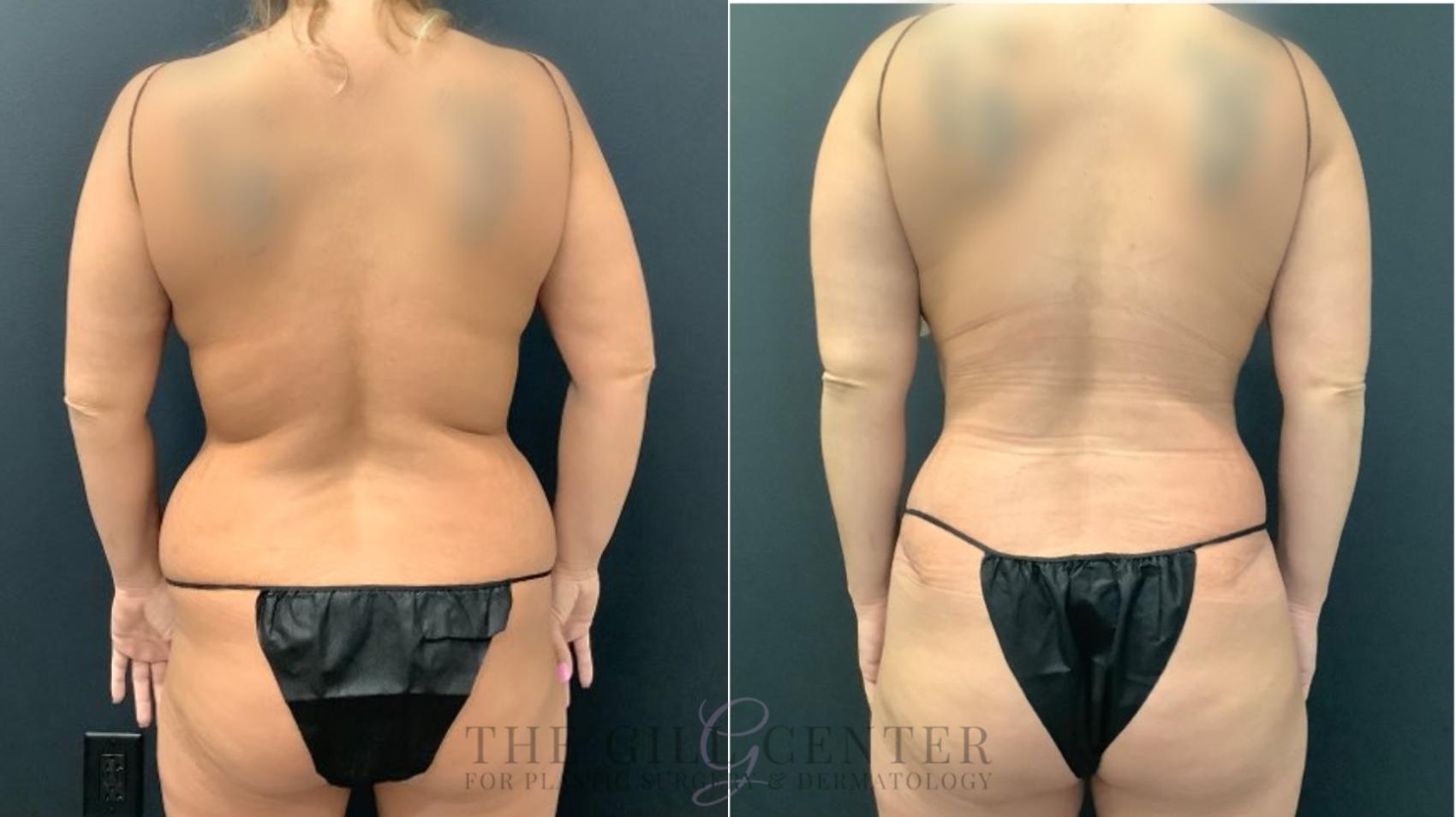 Liposuction Case 553 Before & After Back | The Woodlands, TX | The Gill Center for Plastic Surgery and Dermatology