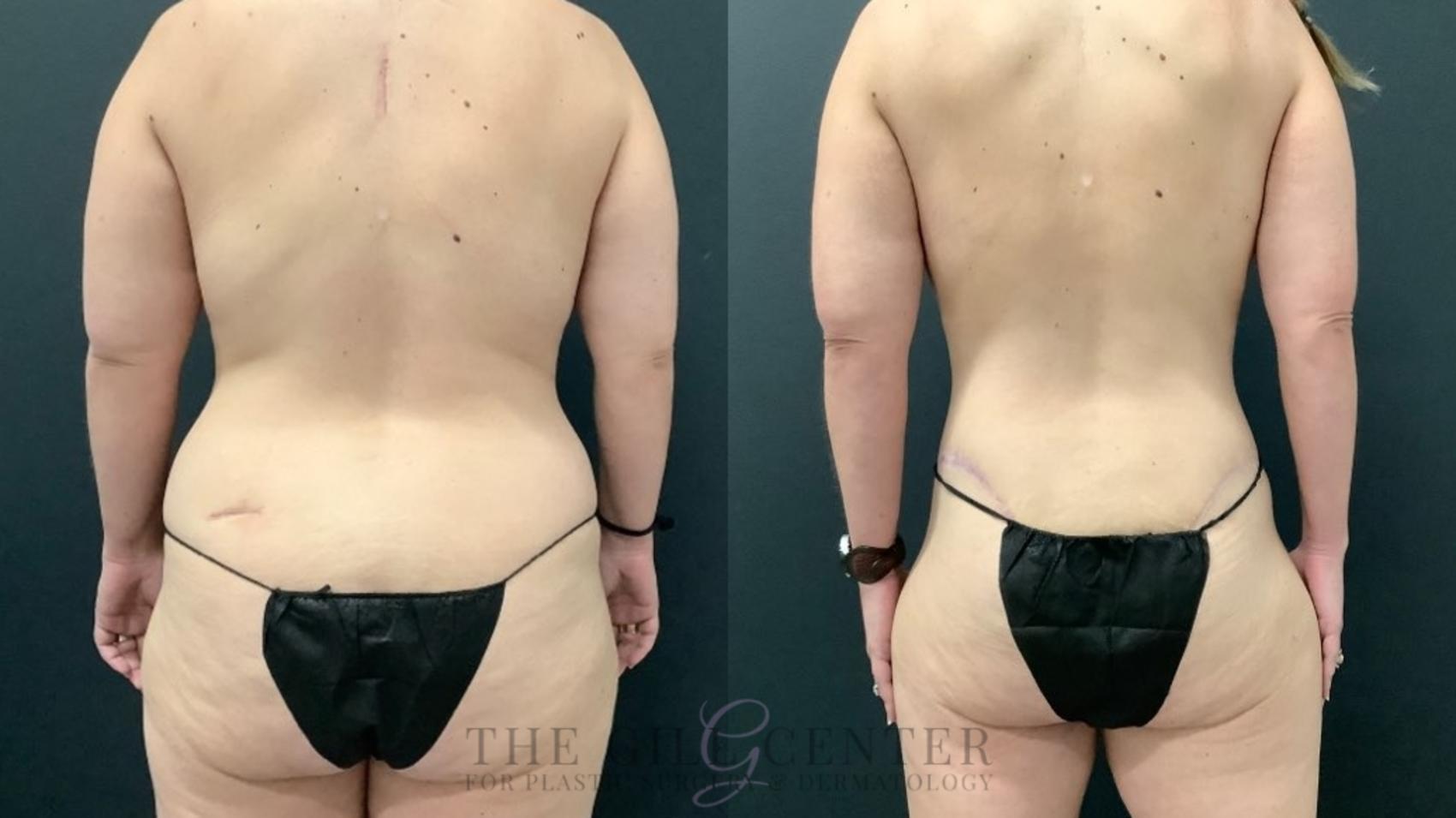 Liposuction Case 555 Before & After Back | The Woodlands, TX | The Gill Center for Plastic Surgery and Dermatology