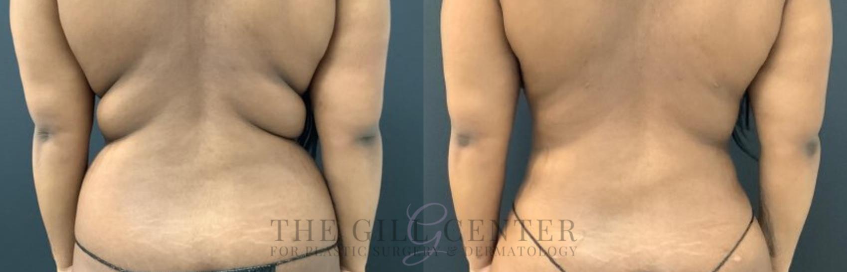 Liposuction Case 574 Before & After Back | The Woodlands, TX | The Gill Center for Plastic Surgery and Dermatology
