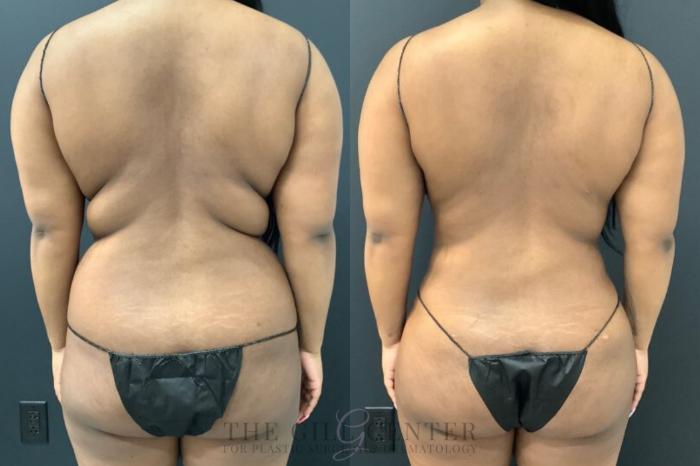 Liposuction Case 574 Before & After Back | The Woodlands, TX | The Gill Center for Plastic Surgery and Dermatology