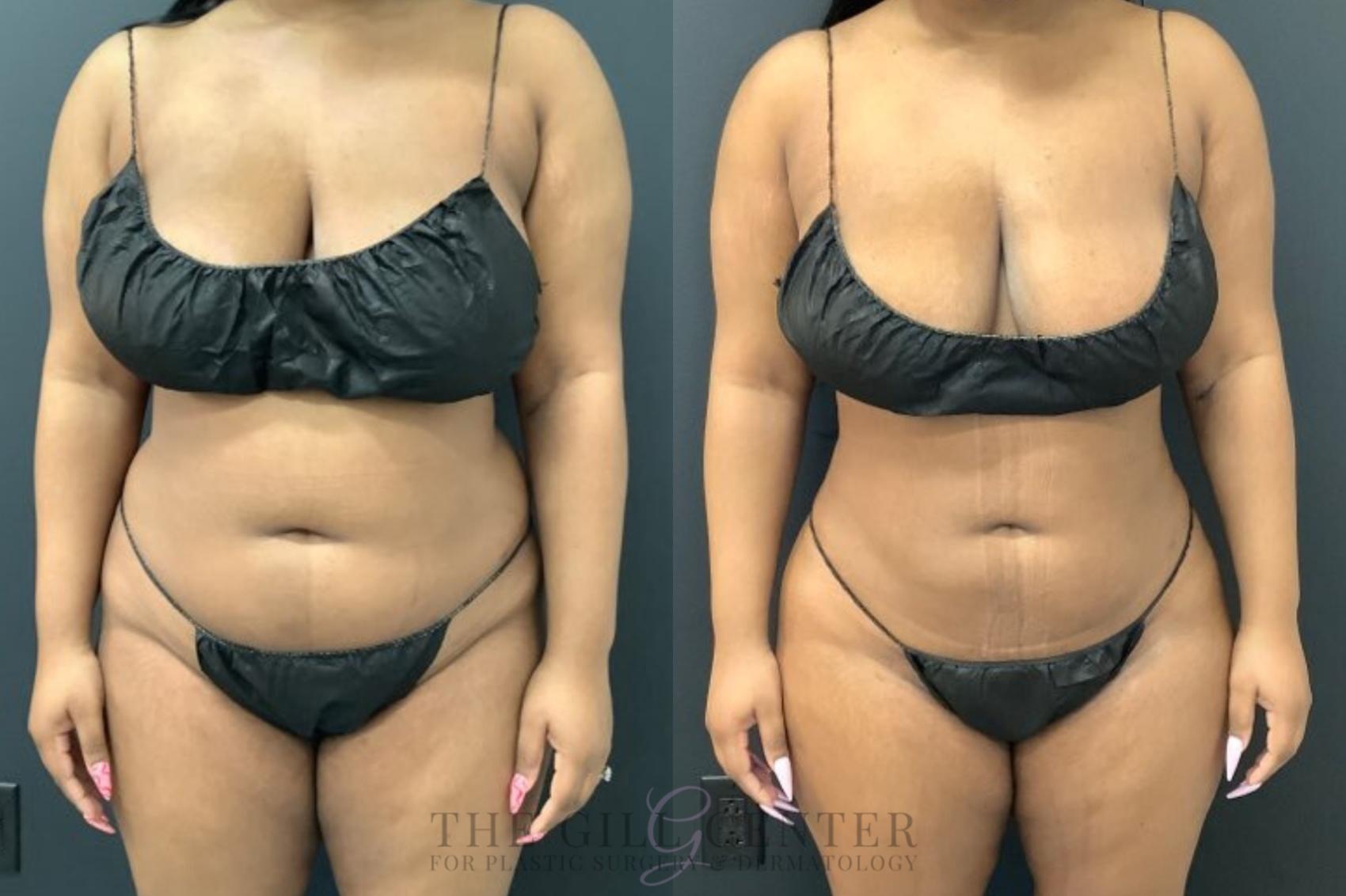 Liposuction Case 574 Before & After Front | The Woodlands, TX | The Gill Center for Plastic Surgery and Dermatology