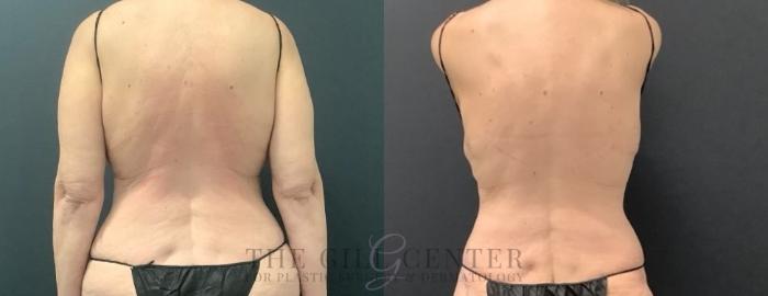 Liposuction Case 718 Before & After Back | The Woodlands, TX | The Gill Center for Plastic Surgery and Dermatology