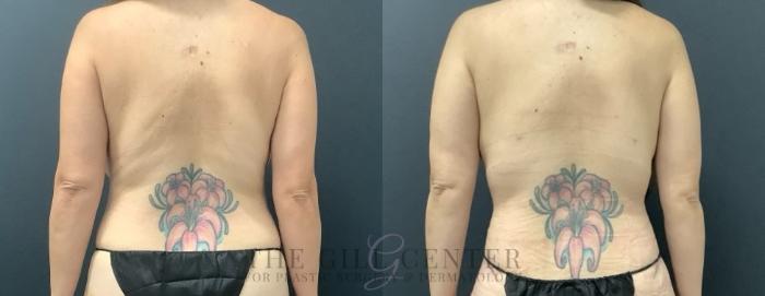 Liposuction Case 719 Before & After Back | The Woodlands, TX | The Gill Center for Plastic Surgery and Dermatology