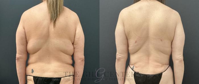 Liposuction Case 738 Before & After Back | The Woodlands, TX | The Gill Center for Plastic Surgery and Dermatology