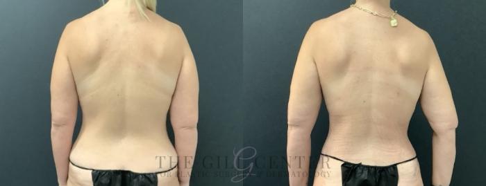 Liposuction Case 743 Before & After Back | The Woodlands, TX | The Gill Center for Plastic Surgery and Dermatology