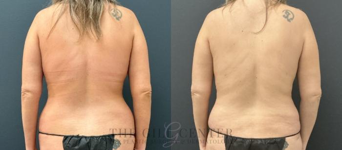 Liposuction Case 752 Before & After Back | The Woodlands, TX | The Gill Center for Plastic Surgery and Dermatology