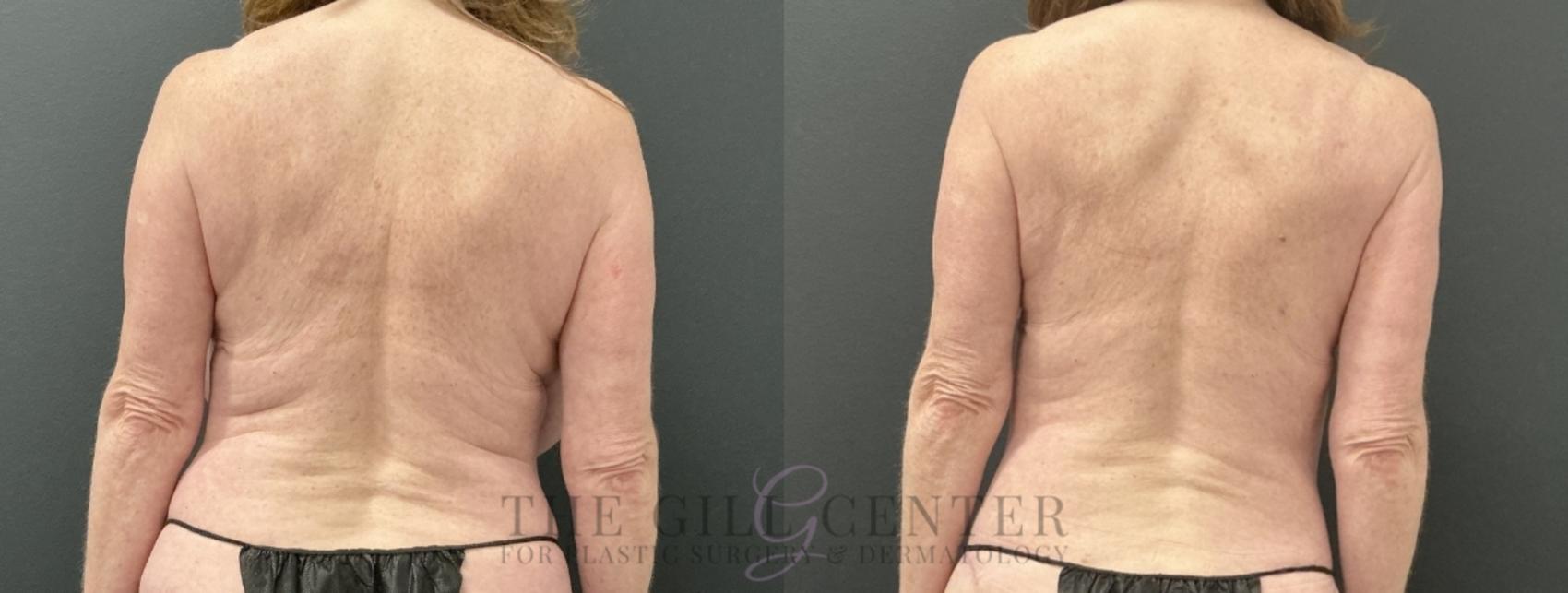 Liposuction Case 758 Before & After Back | The Woodlands, TX | The Gill Center for Plastic Surgery and Dermatology