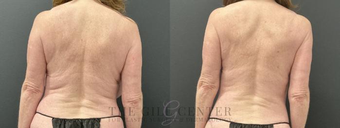 Liposuction Case 758 Before & After Back | The Woodlands, TX | The Gill Center for Plastic Surgery and Dermatology