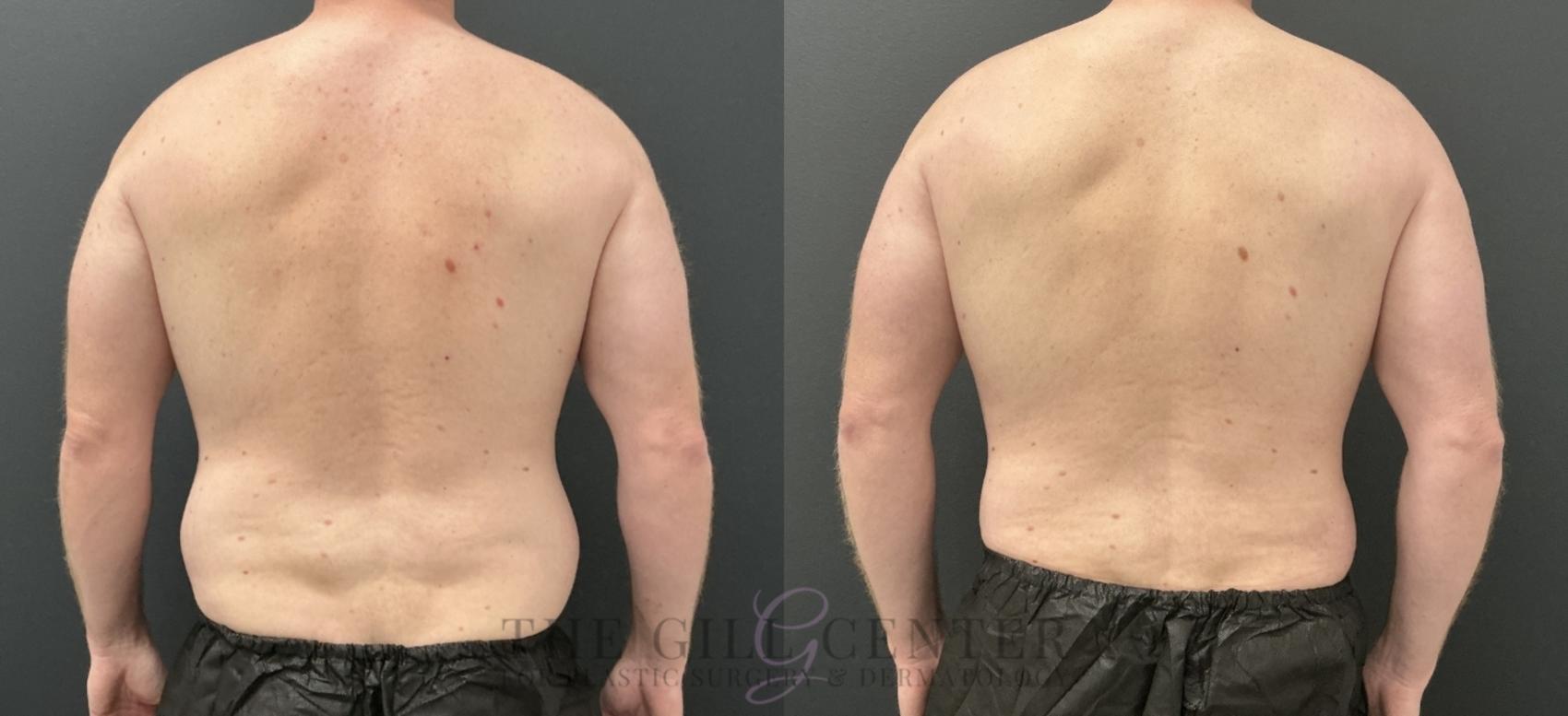 Liposuction Case 761 Before & After Back | The Woodlands, TX | The Gill Center for Plastic Surgery and Dermatology