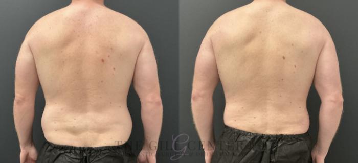 Liposuction Case 761 Before & After Back | The Woodlands, TX | The Gill Center for Plastic Surgery and Dermatology