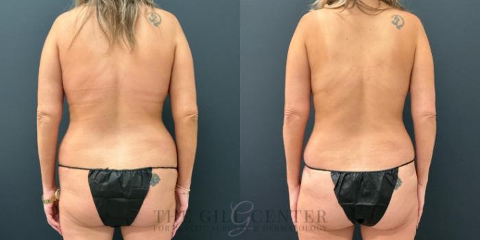 Liposuction Case 771 Before & After Back | The Woodlands, TX | The Gill Center for Plastic Surgery and Dermatology