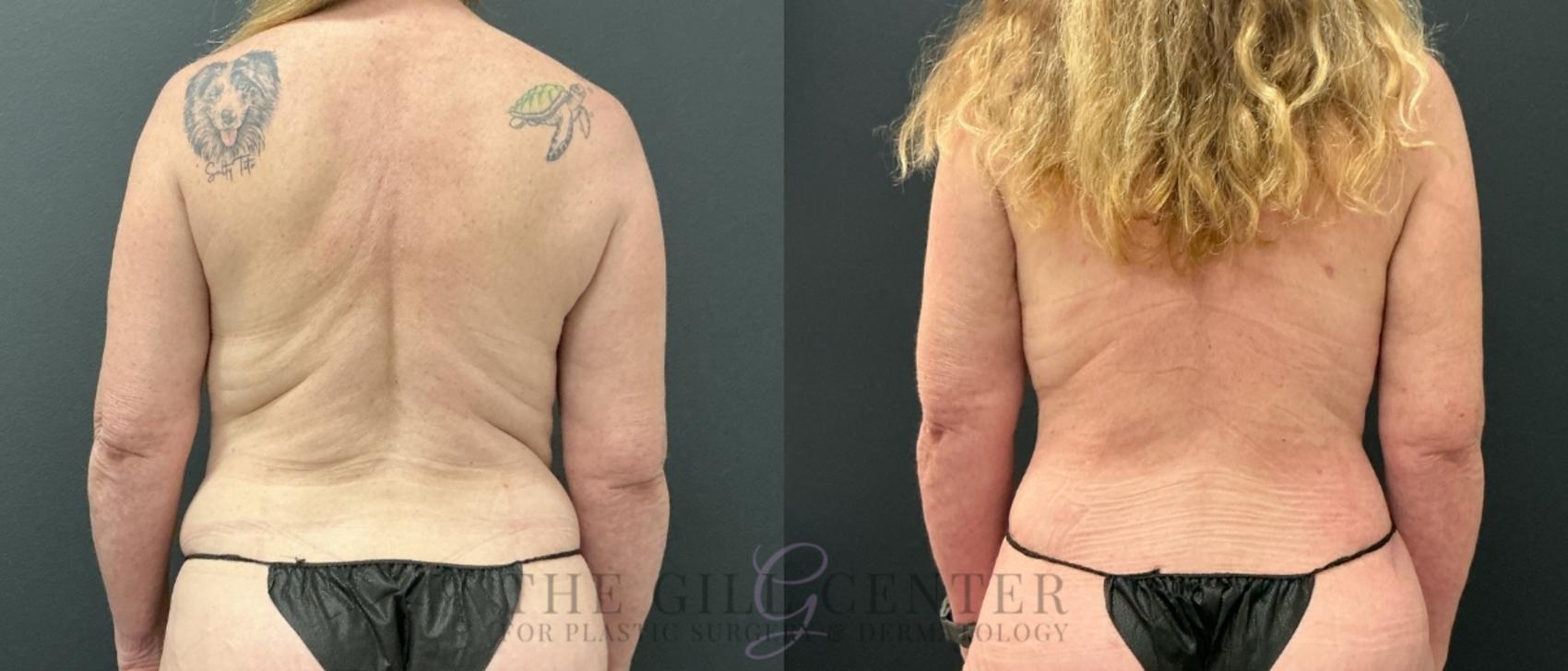 Liposuction Case 774 Before & After Back | The Woodlands, TX | The Gill Center for Plastic Surgery and Dermatology