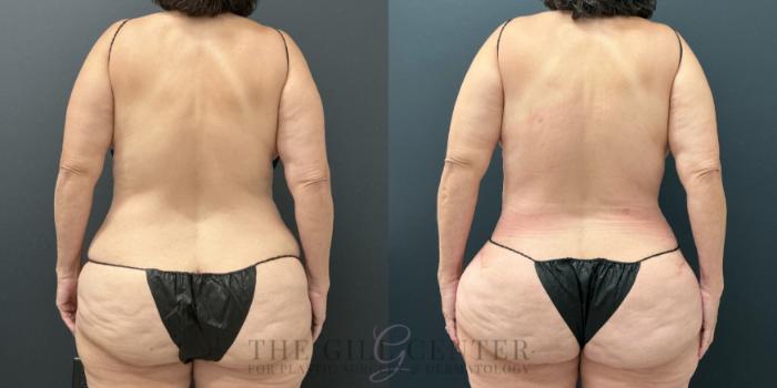 Liposuction Case 780 Before & After Back | The Woodlands, TX | The Gill Center for Plastic Surgery and Dermatology