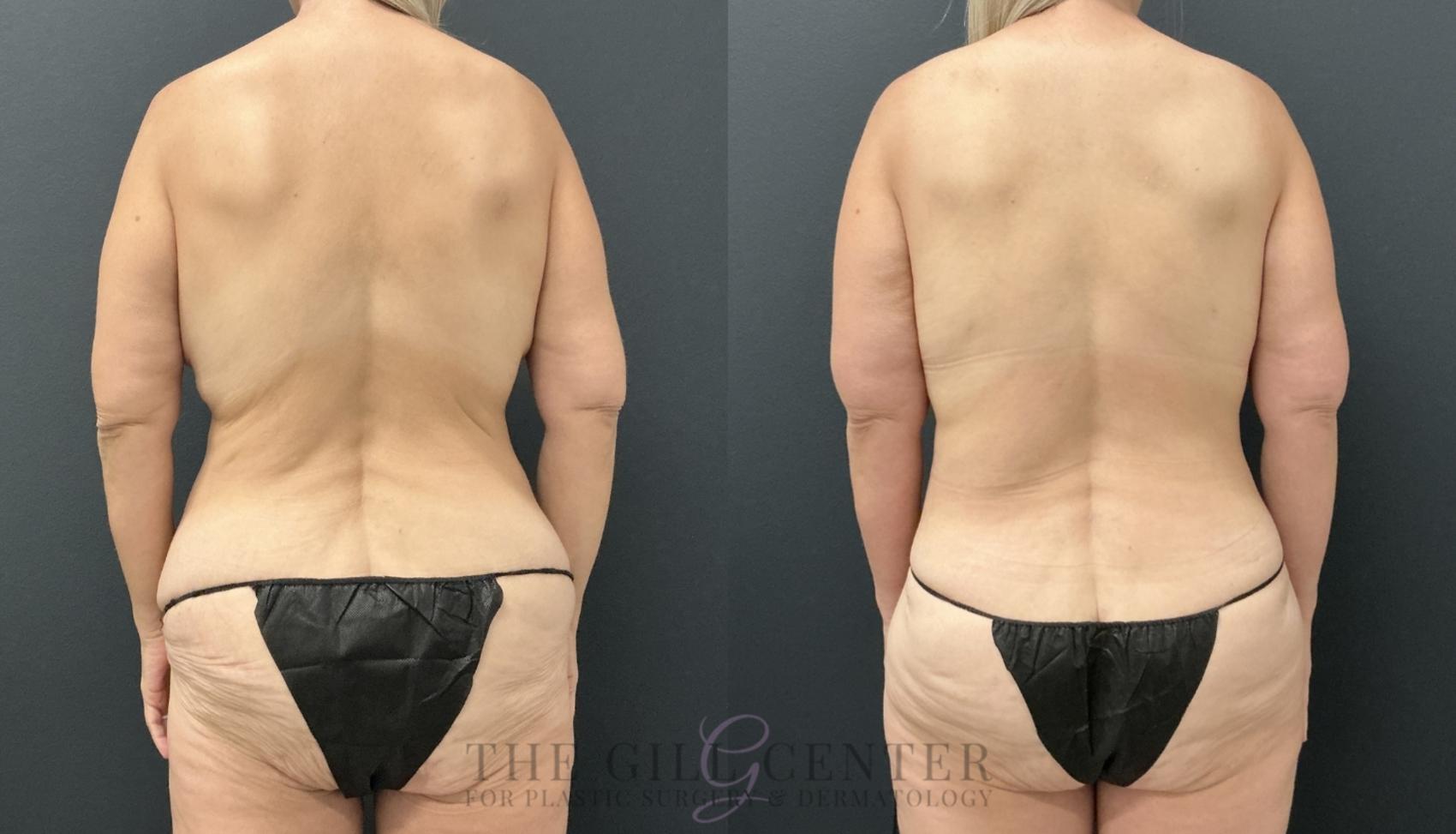 Liposuction Case 792 Before & After Back | The Woodlands, TX | The Gill Center for Plastic Surgery and Dermatology