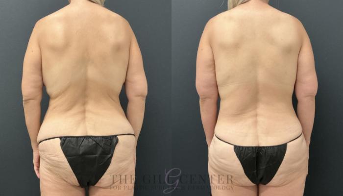 Liposuction Case 792 Before & After Back | The Woodlands, TX | The Gill Center for Plastic Surgery and Dermatology