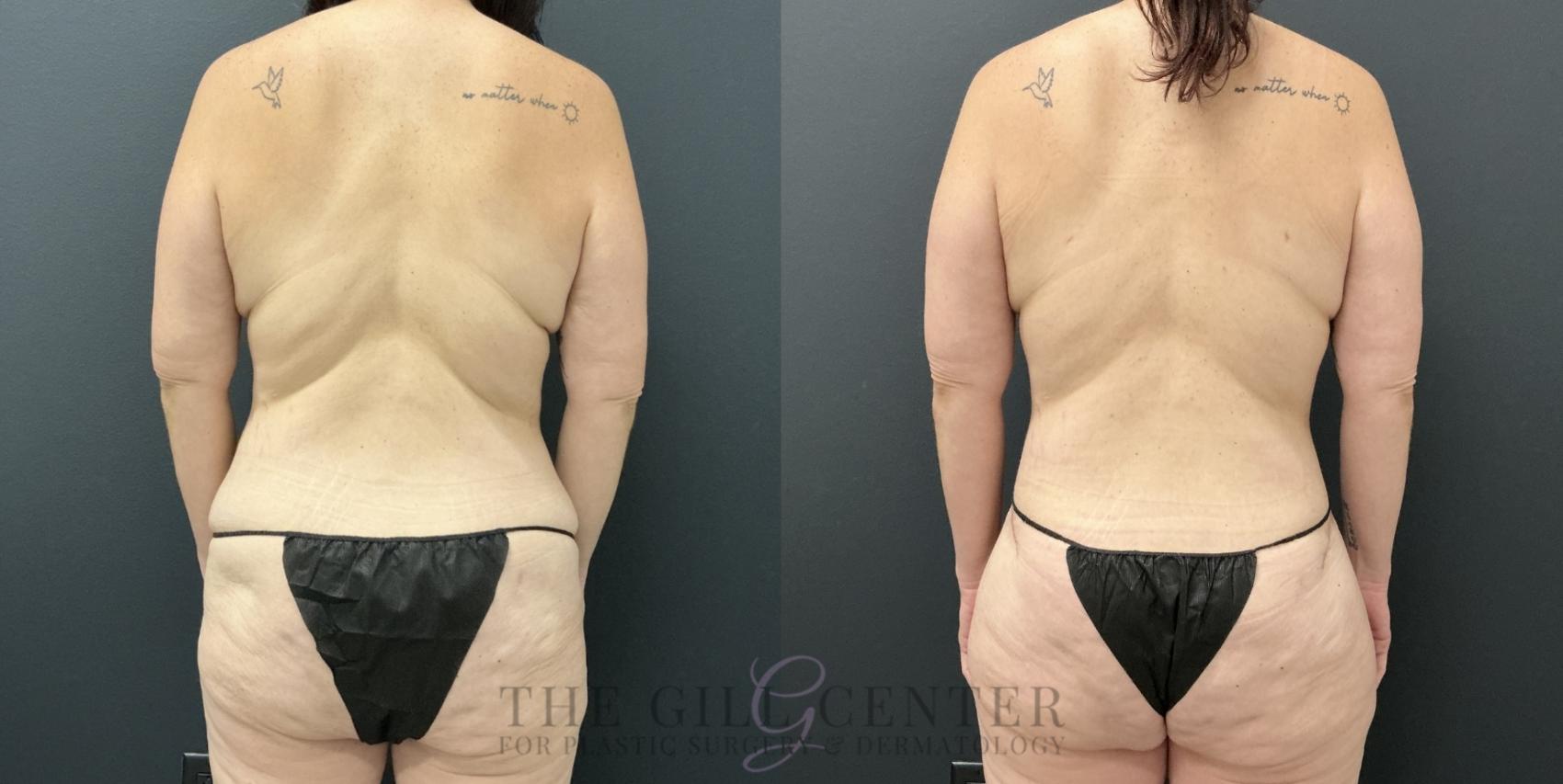 Liposuction Case 794 Before & After Back | The Woodlands, TX | The Gill Center for Plastic Surgery and Dermatology