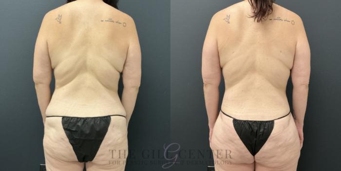 Liposuction Case 794 Before & After Back | The Woodlands, TX | The Gill Center for Plastic Surgery and Dermatology