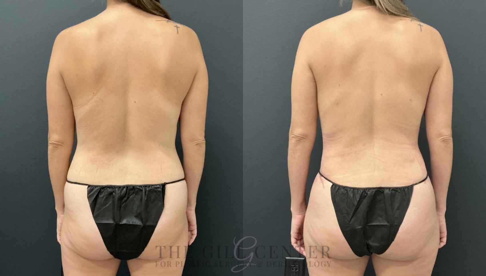 Liposuction Case 796 Before & After Back | The Woodlands, TX | The Gill Center for Plastic Surgery and Dermatology