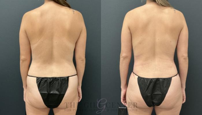 Liposuction Case 796 Before & After Back | The Woodlands, TX | The Gill Center for Plastic Surgery and Dermatology