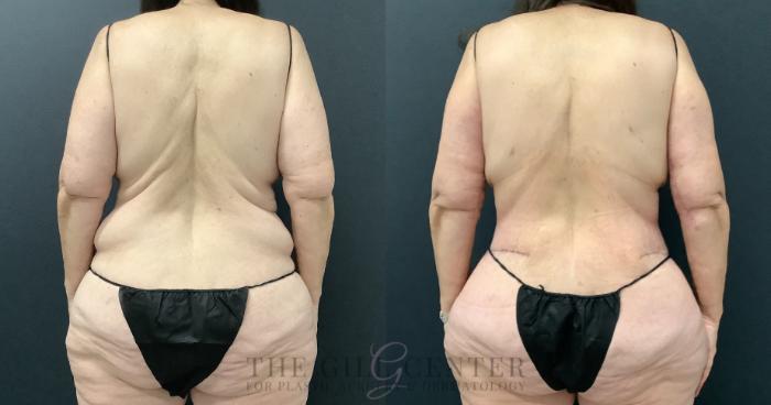 Liposuction Case 798 Before & After Back | The Woodlands, TX | The Gill Center for Plastic Surgery and Dermatology