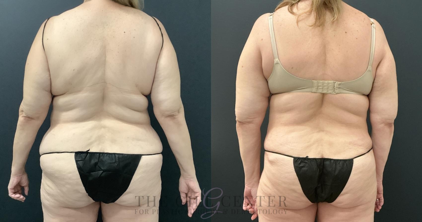 Liposuction Case 804 Before & After Back | The Woodlands, TX | The Gill Center for Plastic Surgery and Dermatology