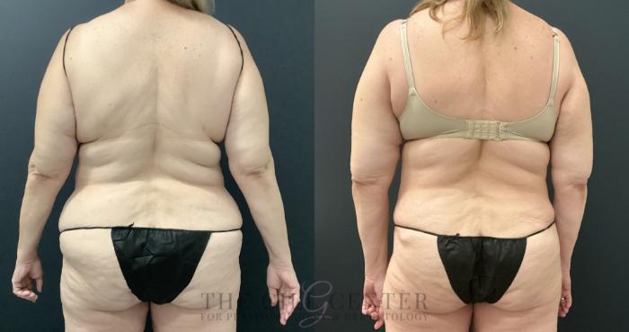 Liposuction Case 804 Before & After Back | The Woodlands, TX | The Gill Center for Plastic Surgery and Dermatology