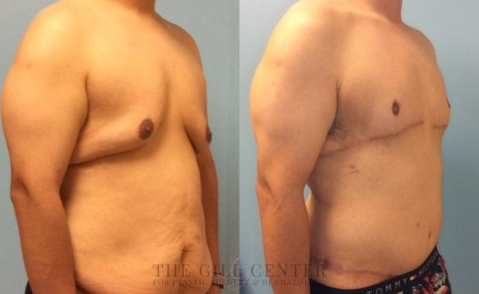 Male Body Contouring Case 335 Before & After Right Oblique | The Woodlands, TX | The Gill Center for Plastic Surgery and Dermatology
