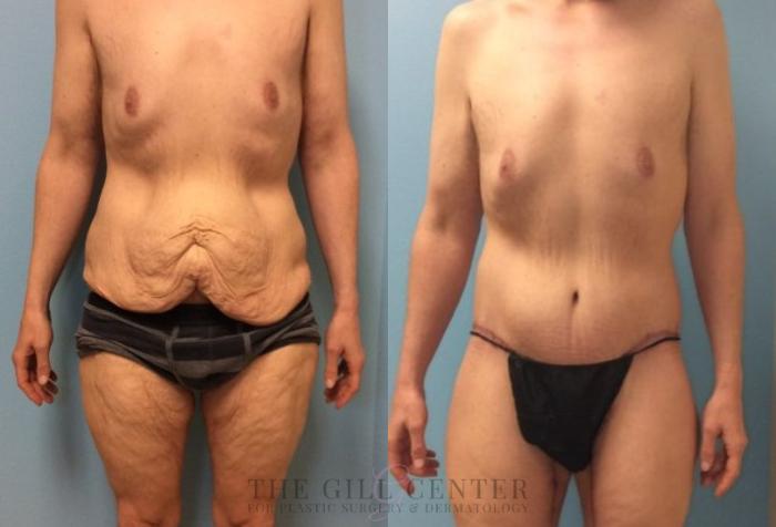 Male Body Contouring Case 336 Before & After Front | The Woodlands, TX | The Gill Center for Plastic Surgery and Dermatology