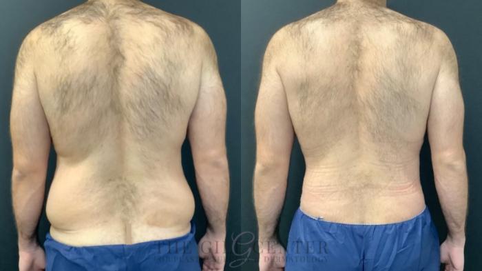 Male Body Contouring Case 476 Before & After Back | The Woodlands, TX | The Gill Center for Plastic Surgery and Dermatology