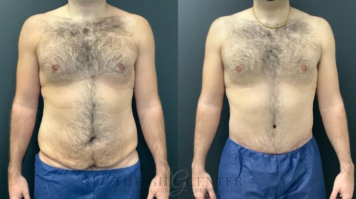 Male Body Contouring Case 476 Before & After Front | The Woodlands, TX | The Gill Center for Plastic Surgery and Dermatology