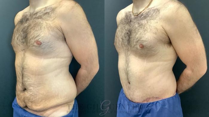 Male Body Contouring Case 476 Before & After Left Oblique | The Woodlands, TX | The Gill Center for Plastic Surgery and Dermatology