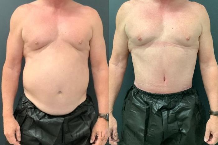 Male Body Contouring Case 546 Before & After Front | The Woodlands, TX | The Gill Center for Plastic Surgery and Dermatology