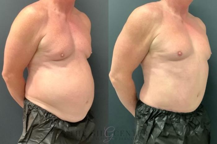 Male Body Contouring Case 546 Before & After Right Oblique | The Woodlands, TX | The Gill Center for Plastic Surgery and Dermatology