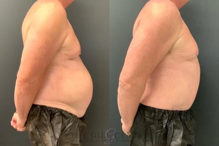 Male Body Contouring Case 546 Before & After Right Side | The Woodlands, TX | The Gill Center for Plastic Surgery and Dermatology