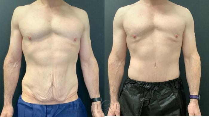Male Body Contouring Case 547 Before & After Front | The Woodlands, TX | The Gill Center for Plastic Surgery and Dermatology