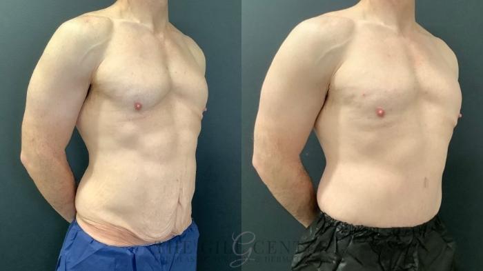 Male Body Contouring Case 547 Before & After Right Oblique | The Woodlands, TX | The Gill Center for Plastic Surgery and Dermatology