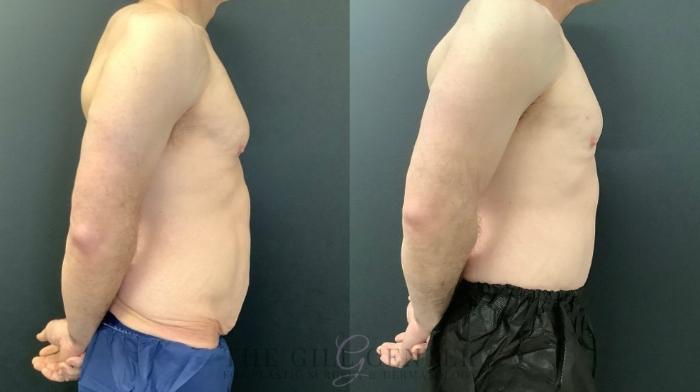 Male Body Contouring Case 547 Before & After Right Side | The Woodlands, TX | The Gill Center for Plastic Surgery and Dermatology