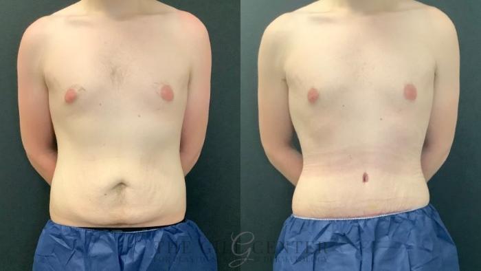 Male Body Contouring Case 548 Before & After Front | The Woodlands, TX | The Gill Center for Plastic Surgery and Dermatology