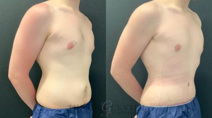 Male Body Contouring Case 548 Before & After Right Oblique | The Woodlands, TX | The Gill Center for Plastic Surgery and Dermatology