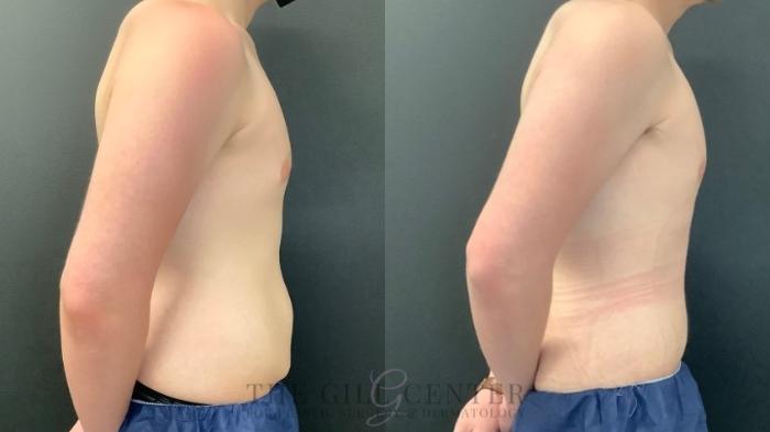 Male Body Contouring Case 548 Before & After Right Side | The Woodlands, TX | The Gill Center for Plastic Surgery and Dermatology