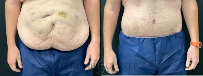 Male Body Contouring Case 549 Before & After Front | The Woodlands, TX | The Gill Center for Plastic Surgery and Dermatology