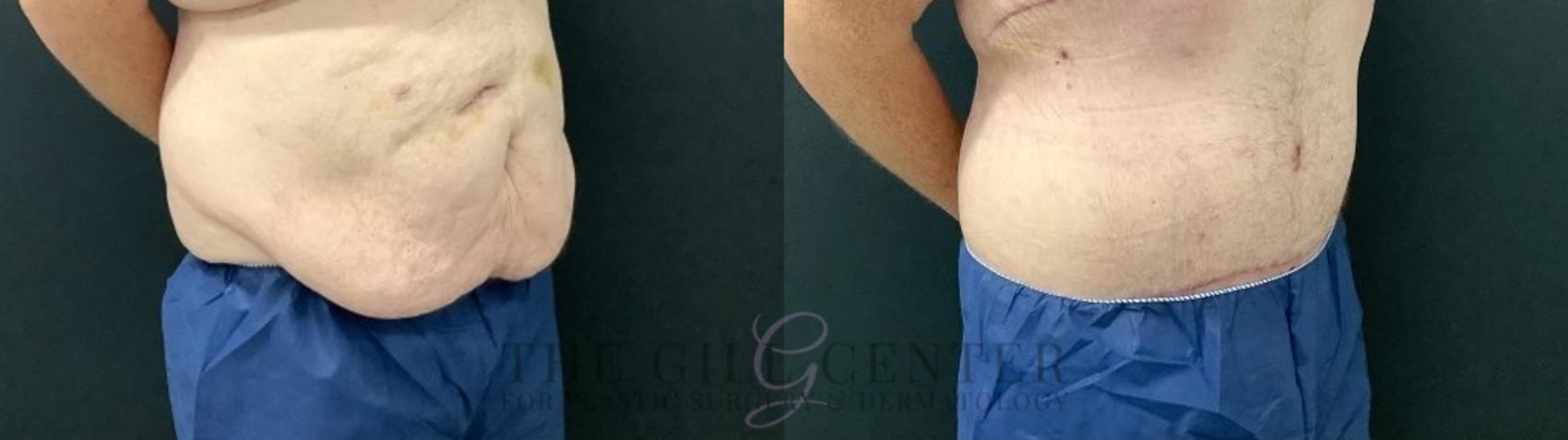 Male Body Contouring Case 549 Before & After Right Oblique | The Woodlands, TX | The Gill Center for Plastic Surgery and Dermatology
