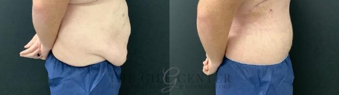 Male Body Contouring Case 549 Before & After Right Side | The Woodlands, TX | The Gill Center for Plastic Surgery and Dermatology