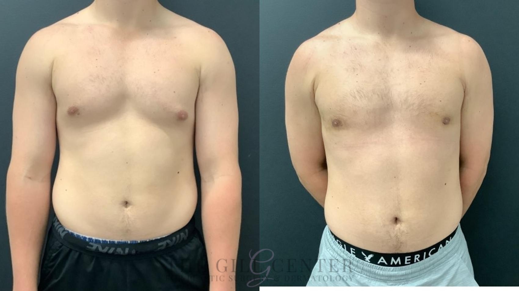 Gynecomastia Case 556 Before & After Front | The Woodlands, TX | The Gill Center for Plastic Surgery and Dermatology