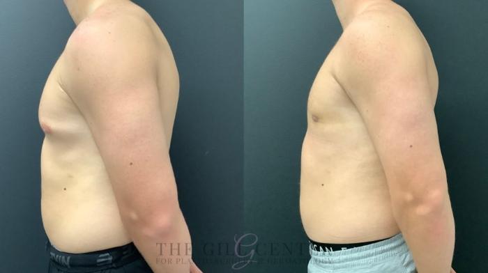 Gynecomastia Case 556 Before & After Left Side | The Woodlands, TX | The Gill Center for Plastic Surgery and Dermatology