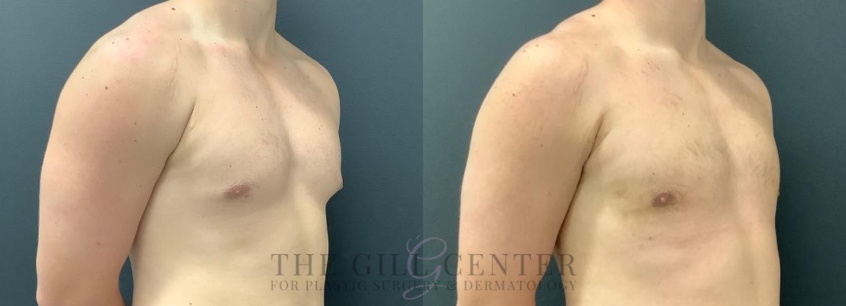 Male Body Contouring Case 556 Before & After Right Oblique | The Woodlands, TX | The Gill Center for Plastic Surgery and Dermatology