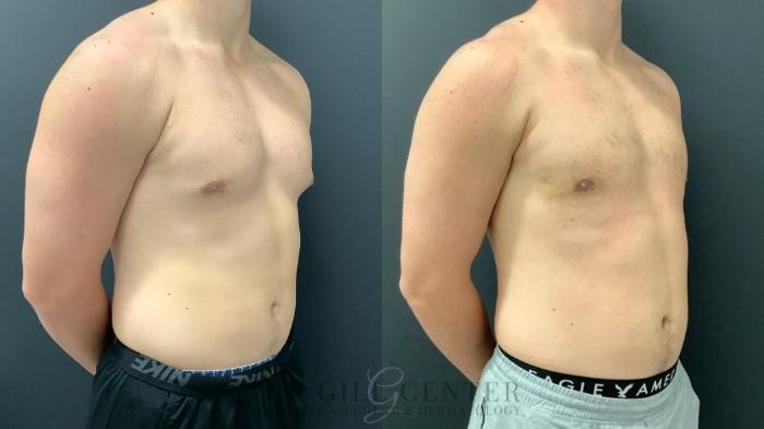 Male Body Contouring Case 556 Before & After Right Oblique | The Woodlands, TX | The Gill Center for Plastic Surgery and Dermatology